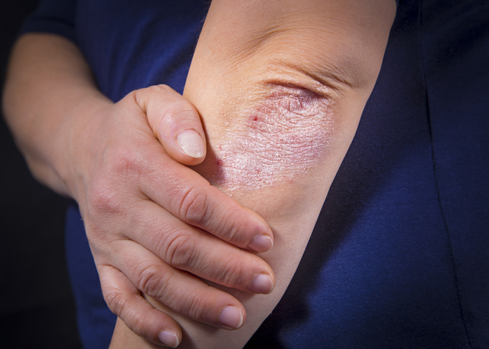 Psoriasis Psoriasis