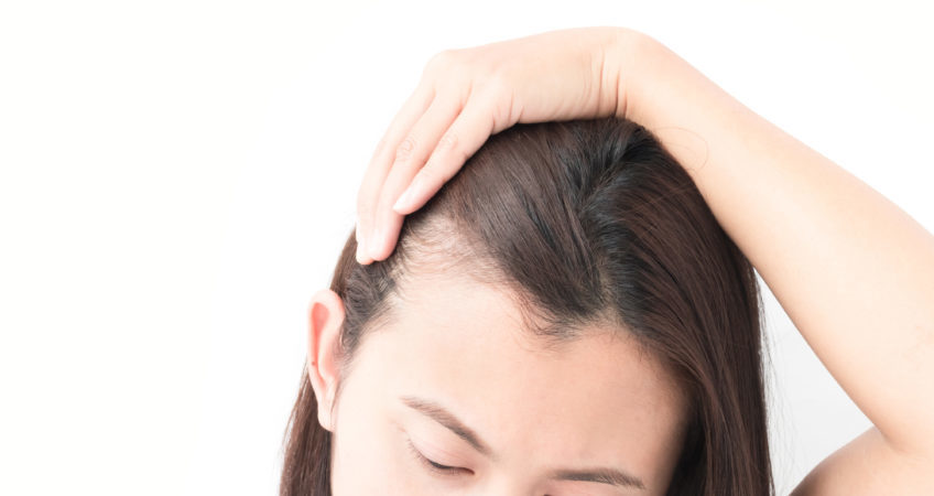 oman serious hair loss problem for health care shampoo and beauty product concept