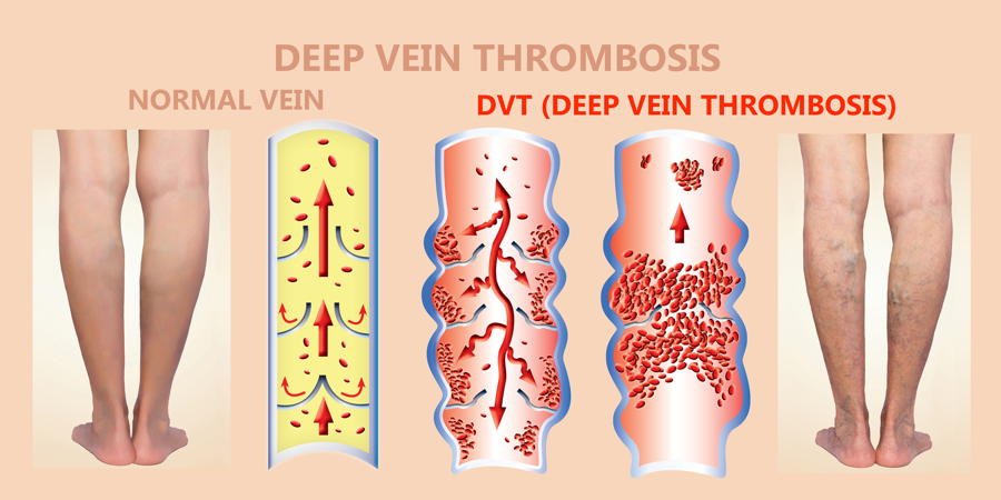 entstehung einer Thrombose