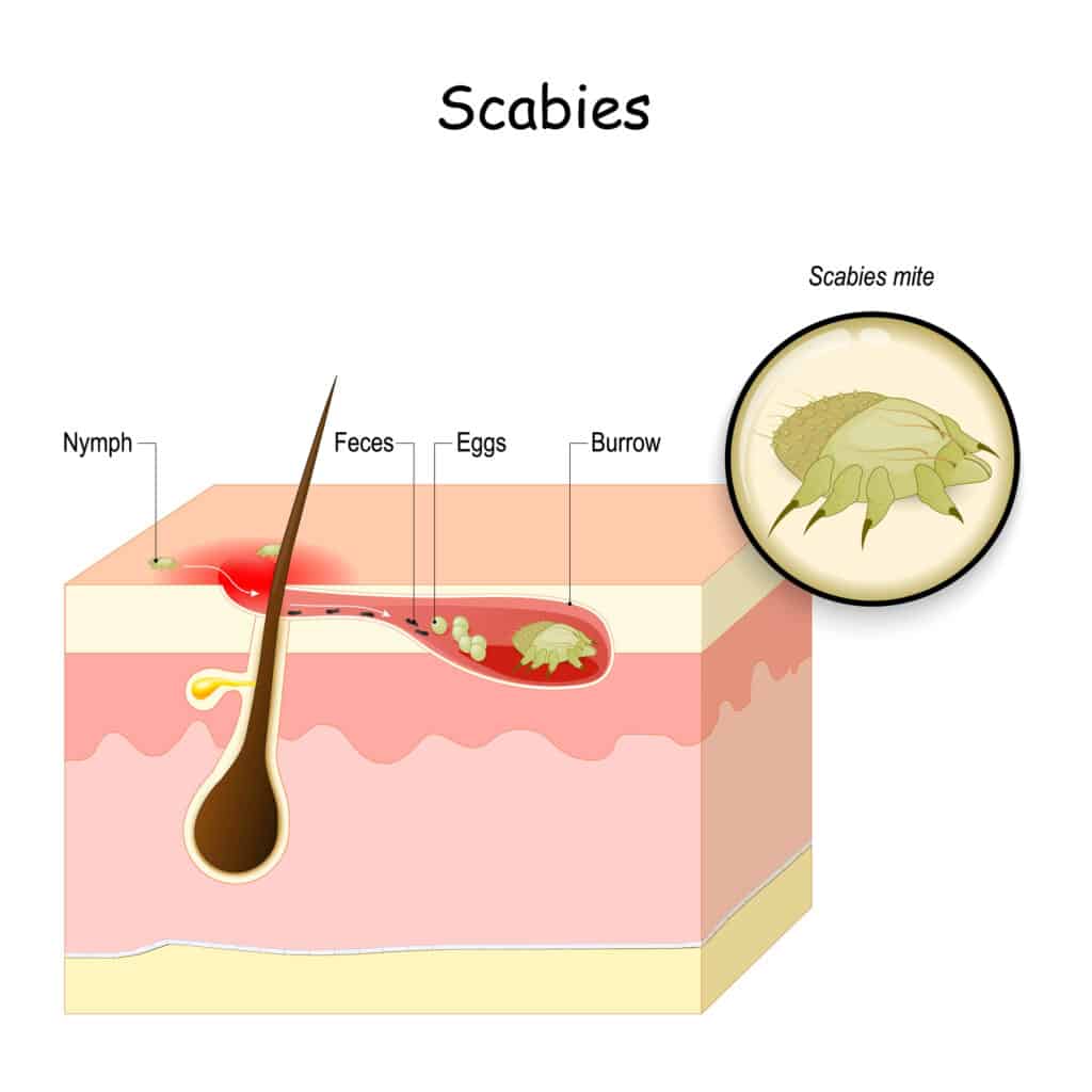 Scabies-Krätze