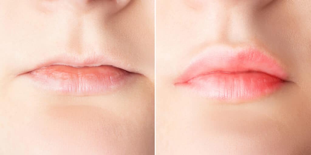 Lippen-aufspritzen
