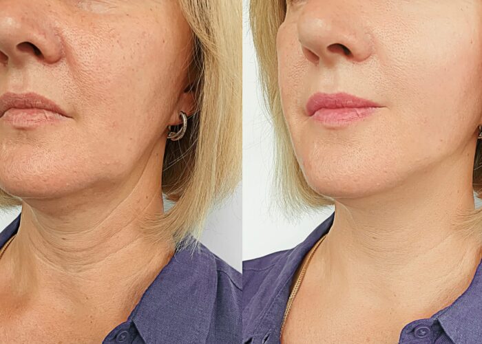 Woman,Face,Wrinkles,After,Treatmen Woman,Face,Wrinkles,After,Treatmen