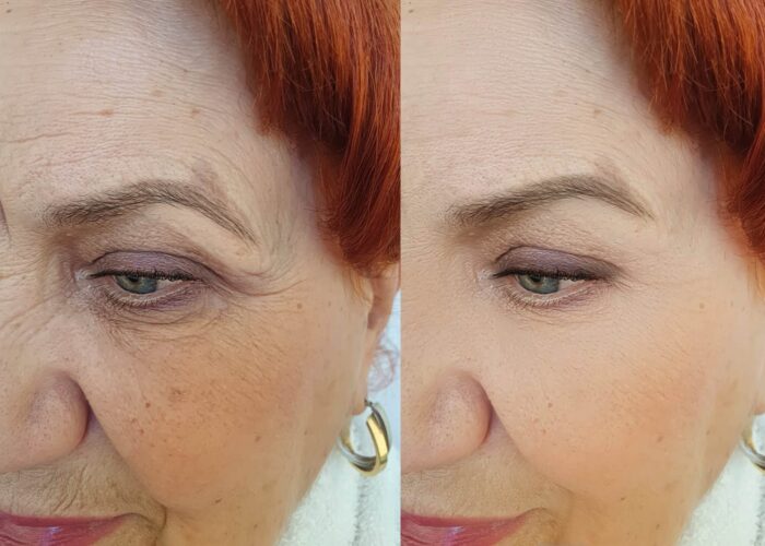Old,Woman,Wrinkles,Eyes,After,Treatment