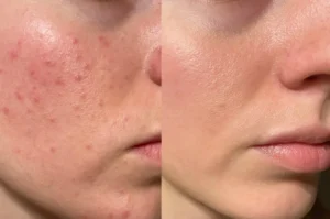 Akne im Gesicht vorher nacher mit Laser behandelt