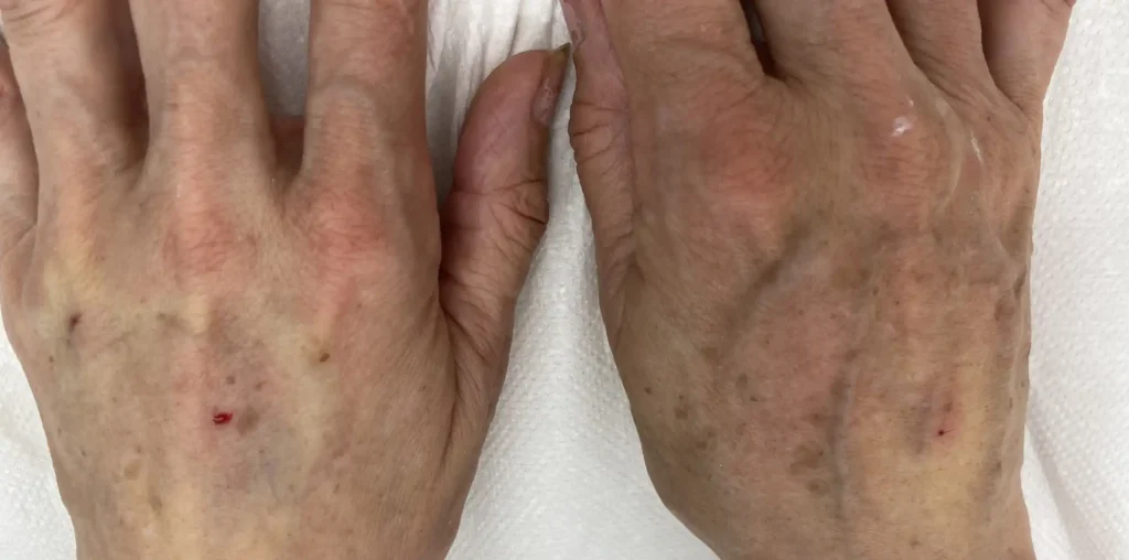 Hände nach der Behandlung mit Hyaluronsäure