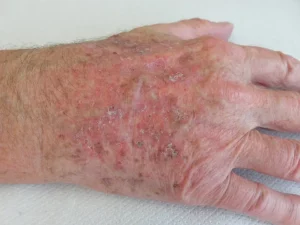 Aktinische Keratosen am Handrücken