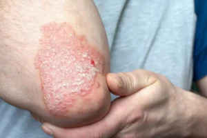 Plaque psoriasis am Ellbogen mit deutlich weißlichen Schuppen und geröteter Haut