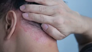 Kopfhautpsoriasis Schuppenflechte im Nackenbereich und Haaransatz bei einem Erwachsenen