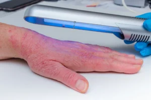 Lichttherapie bei Schuppenflechte