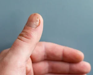 Nagelpsoriasis Nagelveränderungen mit Rillen oder bräunlich/schwärzlichen Punkten