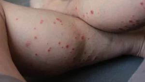 Psoriasis guttata kleinfleckige Psoriasisherde oft auf großen Arealen verteilt, rötliche Färbung und weniger Schuppen