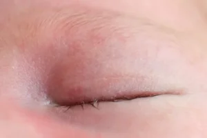 Kosmetisch schöne Naht – intrakutane Naht