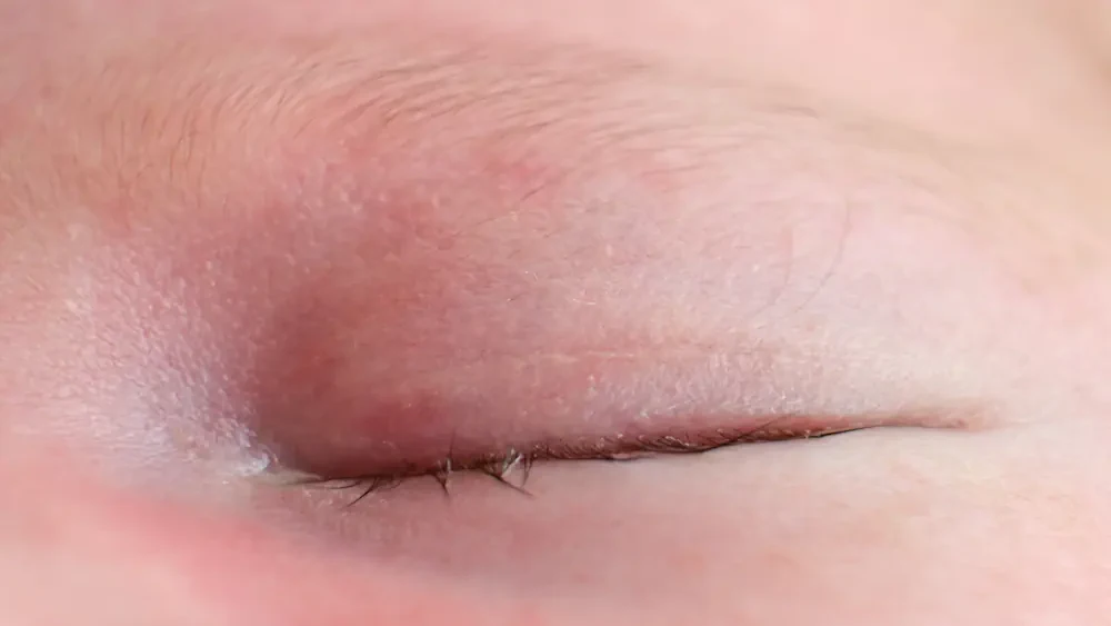 Intrakutannaht nach 3 Monaten