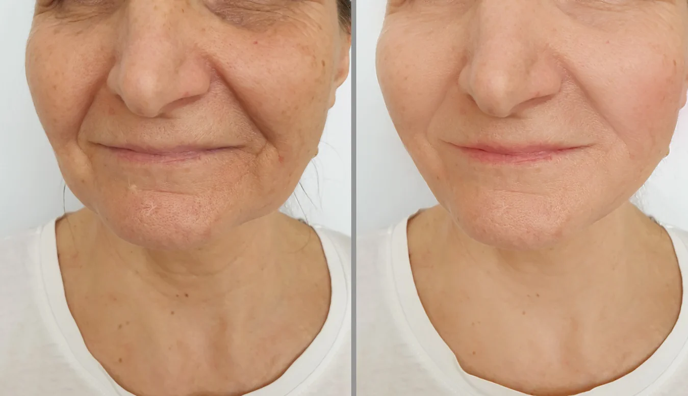 Fadenlifting Wien kombiniert mit fraktioniertem Erbiumlaser zur Hautverjüngung