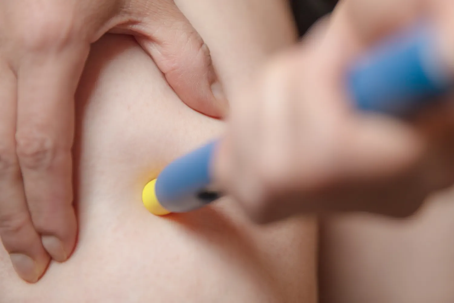 Biologica-Therapie bei Psoriasis und Neurodermitis