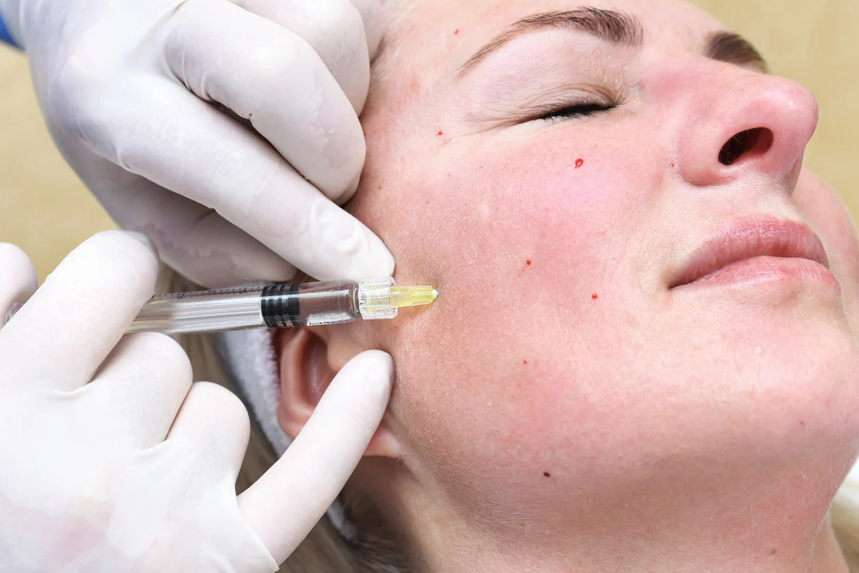Hyaluronsäure-Behandlung im Rahmen eines individuellen 8-Point-Lift-Konzepts zur natürlichen Gesichtsverjüngung