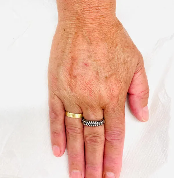 Hand nach der Unterspritzung mit Hyaluronsäure