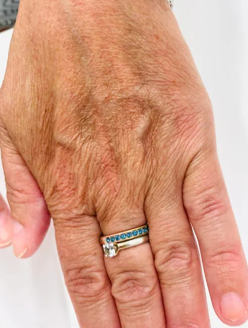 Hand vor der Unterspritzung mit Hyaluronsäure